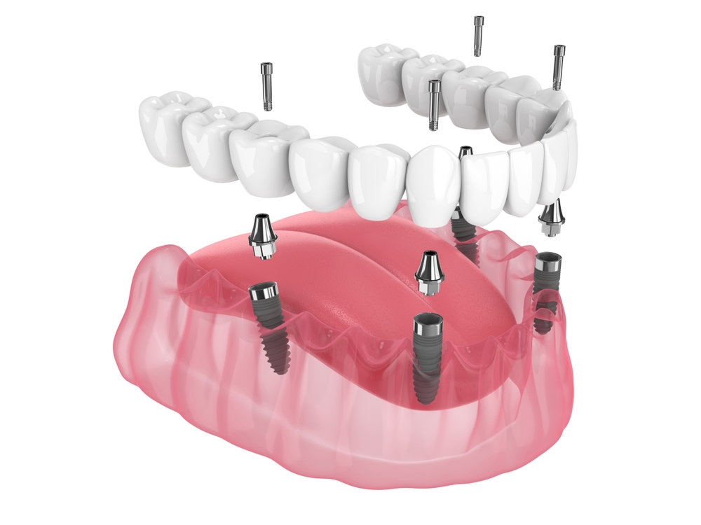 Full arch dental implant bridge with titanium posts