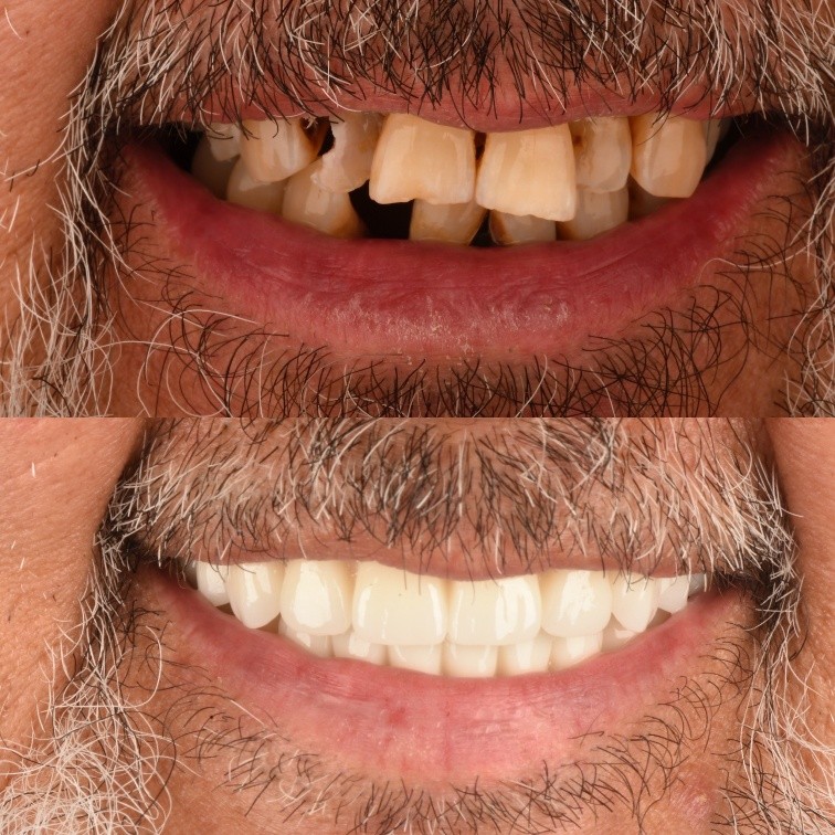Before and after All-on-X full-arch restoration of a male patient's smile