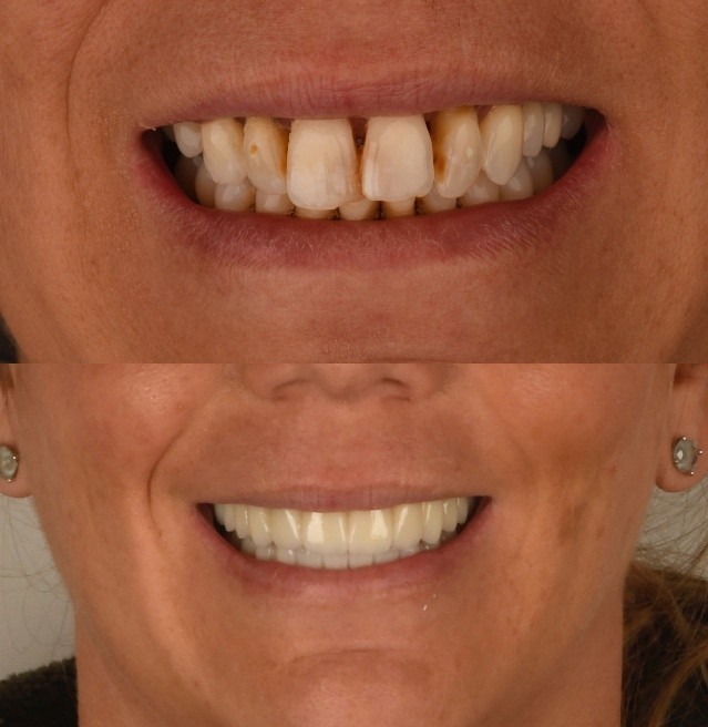 Before and after All-on-X full-arch restoration of a female patient's smile