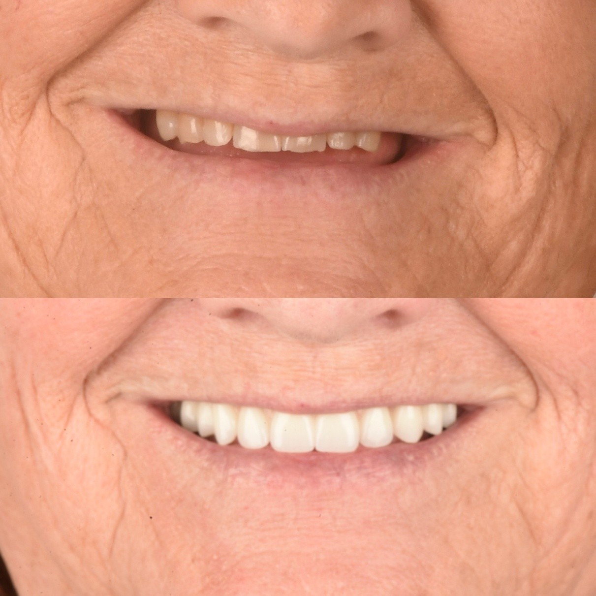 Before and after full-arch implant restoration of a patient's smile